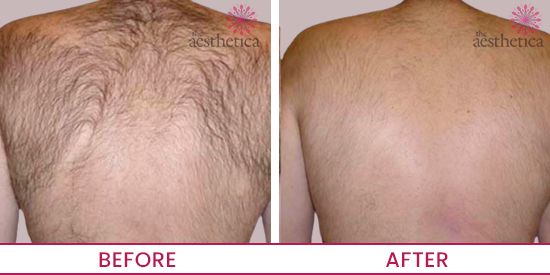 How Many Laser Treatments for Permanent Hair Removal are Effective