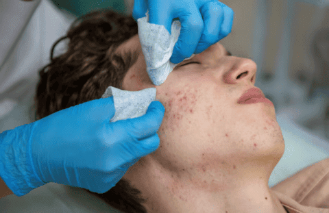Acne_Acne Scar Treatments